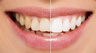 Jak wybielić zęby?
