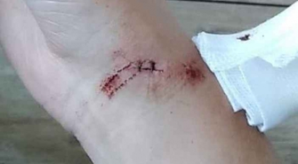 Dwie nastolatki z pociętymi twarzami