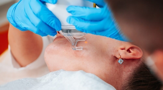 Usuwanie przebarwień z wykorzystaniem wąskopasmowego światła pulsacyjnego - na czym polega?